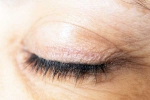 Eyelash Dandruff, Eyelash Dandruff, all about eyelash dandruff, Conjunctivitis