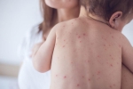 measles, measles, measles back in the united states as children omit vaccination doses, Toddler